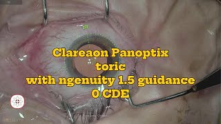 Clear lens exchange  Using of ngenuity 15 for toric IOL alignment [upl. by Anyr]