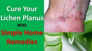 Cure Your Lichen Planus With These Simple Home Remedies [upl. by Arrahs]