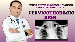 Cervicothoracic sign  Must Know classical Signs In thoracic radiology  Thoracic radiology [upl. by Oshinski292]