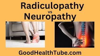 Radiculopathy Versus Neuropathy  Which One Is Yours  Good Health Tube [upl. by Deane]