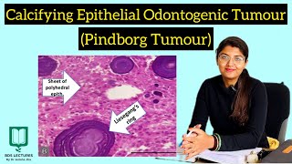 Calcifying Epithelial Odontogenic Tumour  Pindborg Tumour  CEOT  Lecture  21  Oral Pathology [upl. by Noryahs]