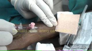 Dorsalis pedis artery cannulation [upl. by Tuneberg]