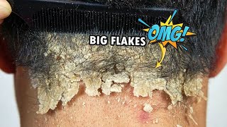 Psoriasis Scalp Scratching Big Flakes 610 [upl. by Notned]