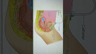 suprapubic catheter shortsvideo exam nursingzone norcet education biology [upl. by Anabella988]