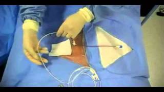 Insertion of Transvenous Pacemaker [upl. by Dupaix191]