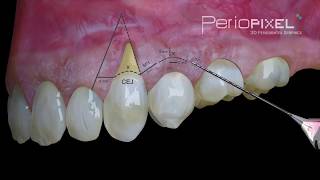 3D dental video  Laterally Moved and Coronally Advanced Flap  PerioPixel [upl. by Airbmac]