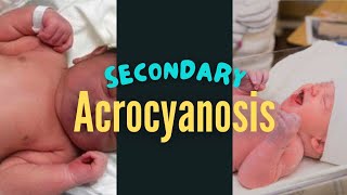 Secondary Acrocyanosis in a Newborn Baby [upl. by Carena458]