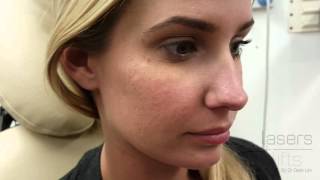 Removing acne scars in 5 minutes [upl. by Mihcaoj]