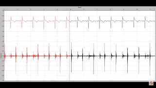 Holosystolic murmur in a child with a membranous ventricular septal defect [upl. by Enneirda]