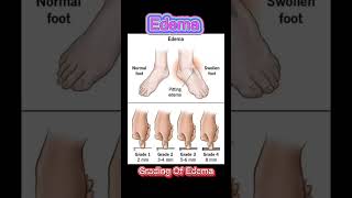 Edema  Pitting Edema  Swelling on legs  What is pitting Edema  Dr Irfan Mughal [upl. by Rasaec414]