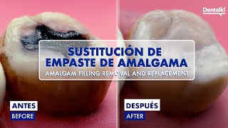 EMPASTE METÁLICO de AMALGAMA  Así se CAMBIA por uno de RESINA PASO a PASO en 4K [upl. by Nhguav576]