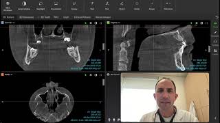 CBCT  Maxillary and Nasal Sinus Concerns  Make sure you are reviewing the entire volumetric image [upl. by Nednarb138]