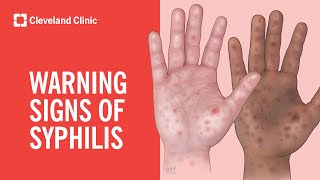 Warning Signs of Syphilis [upl. by Noonberg]