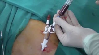 Permanent HD Cath insertion [upl. by Ednutabab]