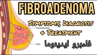 Fibroadenoma a benign lump in young girls breasts UrduHindi [upl. by Yobybab]