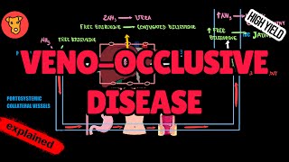 VENOOCCLUSIVE DISEASE Hemodynamics Mechanism of clinical symptoms [upl. by Pandora]