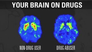 How addiction changes your brain [upl. by Moshe]