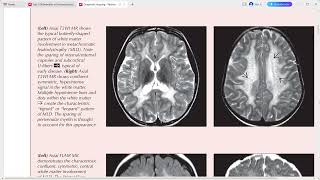 PAEDIATRIC NEURORADIOLOGY DIAGNOSTIC IMAGING [upl. by Trever384]