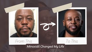 I Tried Minoxidil For 3 Years My Transformation Experience [upl. by Epolenep]