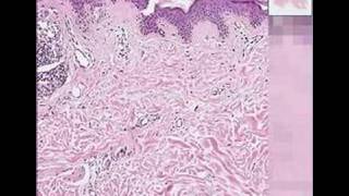 Histopathology SkinCompound nevus with halo reaction [upl. by Mindi582]