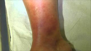 A case of tibial cellulitis before and 24 hours after treatment with antibiotics [upl. by Drice]