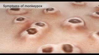 Mpox Monkeypox Animation [upl. by Emiatej251]