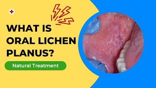 What Is Oral Lichen Planus Homeopathy Treatment Of Oral Lichen Planus [upl. by Kera]