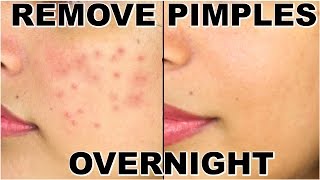 10 Pimple Mistakes  How to Remove Pimples From Face  Remove Acne Naturally [upl. by Leuas]