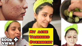 Blackhead Removal  Acne Cystic Treatment  Facial Spa Pimple Popping  Elderly Hidden Acne  076 [upl. by Ylicic]