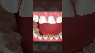 What Is Bruxism and How Is It Treated [upl. by Cochrane70]