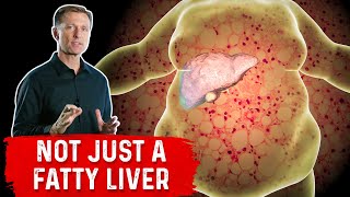 A Fatty Liver Spreads to All of Your Organs [upl. by Tolman]