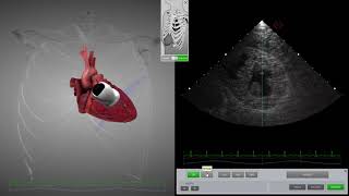 HeartWorks Hypovolemia with Doppler [upl. by Poore]