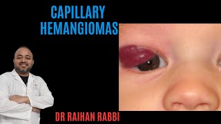 Capillary hemangiomas  eye swelling in children [upl. by Aissilem25]