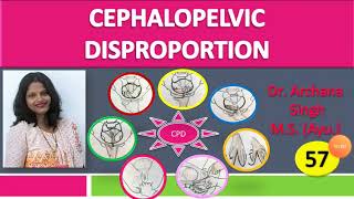 57 Cephalopelvic Disproportion [upl. by Fasto]