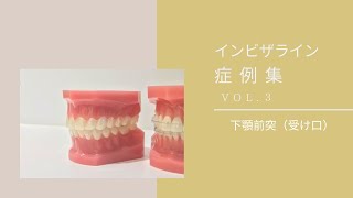 【症例集vol3下顎前突】受け口 症例 インビザライン マウスピース矯正 クリンチェック [upl. by Thibaut]