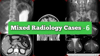 Radiology Viva Cases  172180  Mixes Exam Cases  Hemangioma types and Cases medical radiology [upl. by Phillada]