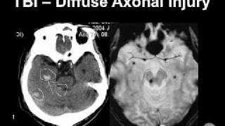 Diagnosing Brain Hemorrhages [upl. by Retrak]