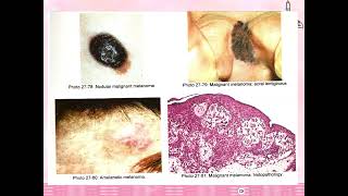 Malignant Melanoma3 [upl. by Vail]