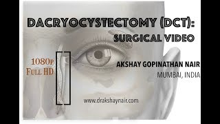 Dacryocystectomy  DCT Lacrimal Mucocele  surgical video Full HD [upl. by Yetnom302]