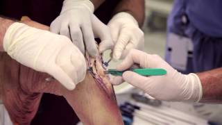 Patellar Tendon Graft [upl. by Jonas1]