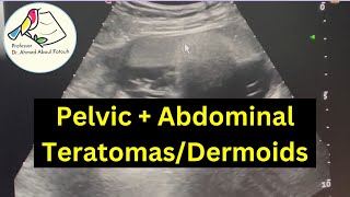 Ultrasound of Pelvic amp Abdominal Teratomas amp Dermoids [upl. by Oaoj311]