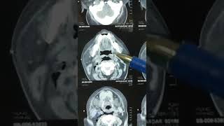 Clinical Case  Retropharyngeal Abscess [upl. by Nazario679]