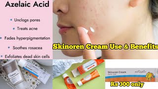 SKINOREN CREAM REVIEW  How to use itSkinoren ko istamal krne ka tariqa 🤔🛑 [upl. by Gilman]