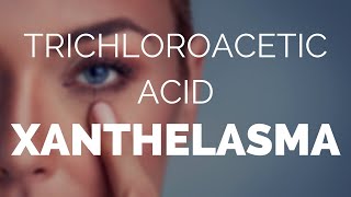 Trichloroacetic acid xanthelasma does it work [upl. by Earehc]