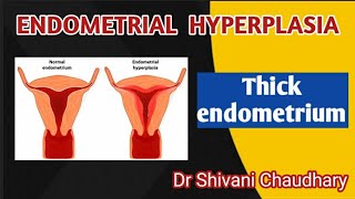 Endometrial hyperplasia  Thick endometrium heavybleeding uterus [upl. by Nylecaj]