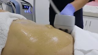 Reduce la flácidez en cuerpo y rostro  Exilis Elite [upl. by Ellennod]