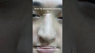 Nose Tip Rhinoplasty Facial Feminising Surgery in Delhi Dr Prabhash nosetip rhinoplastyresults [upl. by Heiner]