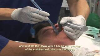 Intubation Extubation 47 [upl. by Habas286]