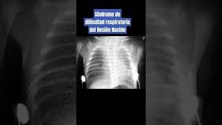 SÍNDROME DE DIFICULTAD RESPIRATORIA DEL RECIÉN NACIDO [upl. by Axela]