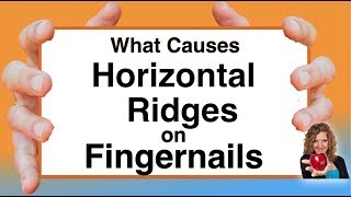 What Causes Horizontal Ridges on Nails With Karen Langston [upl. by Eneiluj]